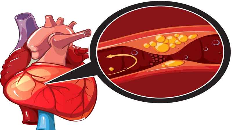 Coronary Heart Disease