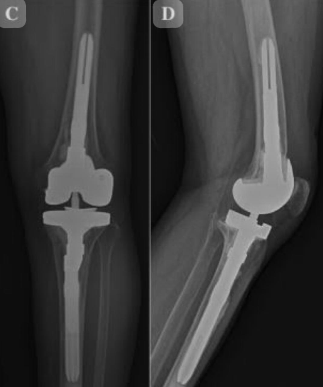 प्रो. नरेंद्र सिंह कुशवाहा के निर्देशन में सफलतापूर्वक दो मरीजों का सफल रिवीजन रिप्लेसमेंट