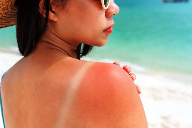 Sunburn Skin Issues