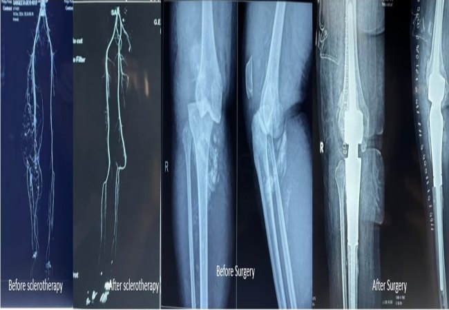 Megaprosthesis Surgery