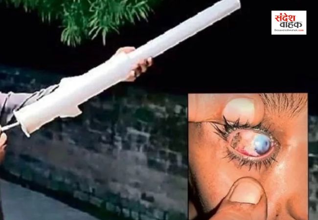 Kanpur News: कानपुर की दीपावली इस बार खुशियों से ज्यादा दर्द और डर की कहानी बन गई है। शहर के अस्पतालों में कार्बाइड पटाखों से झुलसे और घायल मरीजों की संख्या लगातार बढ़ रही है। सबसे चिंताजनक बात यह है कि अब तक 12 मरीज अपनी एक आंख की रौशनी हमेशा के लिए खो चुके हैं। 75 का इलाज 12 नए मरीज यहां हैलट अस्पताल के प्लास्टिक सर्जरी और नेत्र रोग विभाग में शनिवार को ही 12 नए मरीज पहुंचे। इसके अलावा निजी अस्पतालों और क्लीनिकों में भी कई पीड़ित इलाज कराने पहुंचे। डॉक्टरों के मुताबिक, कार्बाइड पटाखों से जलने वाले जख्म आम पटाखों से कहीं ज्यादा खतरनाक होते हैं। इनके पाउडर के कण त्वचा और ऊतकों की गहराई में जम जाते हैं, जिससे घाव भरना बेहद मुश्किल हो जाता है। हैलट के नेत्र रोग विभाग में अब तक 75 मरीजों का इलाज किया जा चुका है, जिनमें 8 मरीजों की एक आंख की रौशनी पूरी तरह चली गई है। वहीं, निजी डॉक्टरों के पास आए 4 और मरीजों की आंखें भी इन पटाखों की बलि बन गईं। वहीं लाला लाजपत राय अस्पताल की वरिष्ठ नेत्र रोग विशेषज्ञ डॉ. शालिनी मोहन का कहना है कि कार्बाइड से आंख की परतें और कॉर्निया बुरी तरह जल जाते हैं। उन्होंने कहा, कार्बाइड के पटाखे खतरनाक रासायनिक प्रतिक्रिया करते हैं। यह न सिर्फ जलाते हैं बल्कि आंख की गहराई तक नुकसान पहुंचाते हैं। ऐसे पटाखों को तुरंत प्रतिबंधित किया जाना चाहिए। बारूद बनाम कार्बाइड जीएसवीएम मेडिकल कॉलेज के प्लास्टिक सर्जन डॉ. प्रेम शंकर के अनुसार, कार्बाइड पटाखों के घाव बारूद वाले पटाखों से कहीं ज्यादा गहरे होते हैं। उन्होंने बताया कि बारूद वाले पटाखों से मांस फटता है, लेकिन कार्बाइड से ऊतक गल जाते हैं। जख्मों में पाउडर भर जाने से संक्रमण बढ़ता है और घाव भरने में कई हफ्ते लग जाते हैं। वहीं डॉ. परवेज़ खान, विभागाध्यक्ष, नेत्र रोग, ने बताया कि ऐसे मामलों में अक्सर कॉर्निया की परत पूरी तरह फट जाती है। साथ ही डॉ. मलय चतुर्वेदी का कहना है कि कार्बाइड के कण एल्केलाइन इंजरी करते हैं। यदि समय रहते इलाज न मिले तो यह 360 डिग्री तक आंख की पूरी संरचना को नुकसान पहुंचा सकते हैं। वहीं कानपुर में इस बार की दीपावली ने साफ कर दिया है कि कार्बाइड पटाखों का चलन आंखों की रौशनी तक छीन सकता है। विशेषज्ञों का कहना है कि प्रशासन को तुरंत इन पटाखों पर सख्त कार्रवाई करनी चाहिए, ताकि अगली दीपावली में कोई भी परिवार अपनी खुशियां इस तरह के दर्द में न गंवाए।