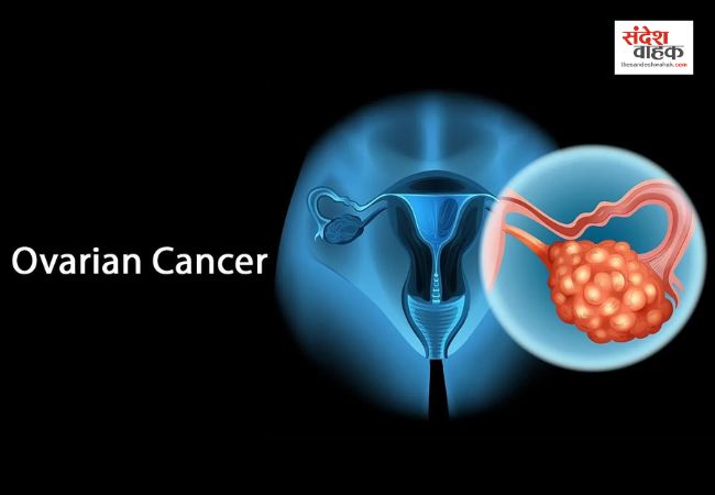 Ovarian कैंसर