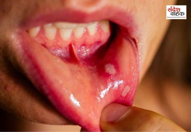 Mouth Ulcers