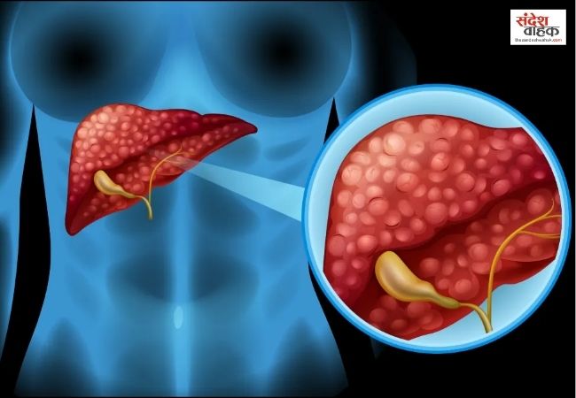 ये है Fatty Liver से लड़ने का आयुर्वेदिक तरीका