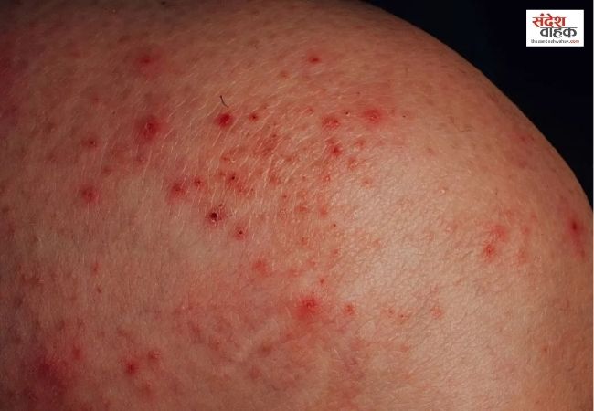 शरीर पर बार-बार Rashes होना हो सकता है गंभीर समस्या का संकेत