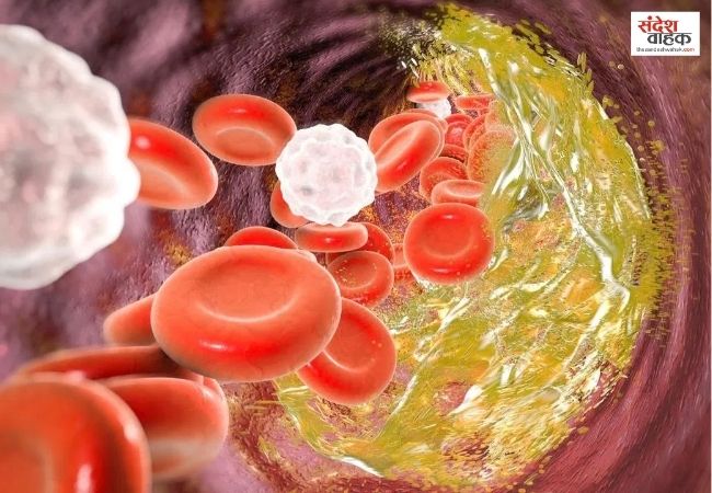 पतले लोगों का भी बढ़ सकता है Cholesterol