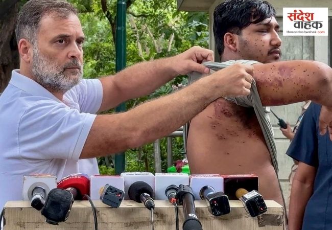 राहुल गांधी ने दिखाए घायल छात्र के जख्म, पैलेट गन चलाने का लगाया आरोप