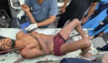 KGMU का कमाल! शरीर में धंसी 4 सरियों के साथ पहुंचा मजदूर, 8 घंटे 40 मिनट की सर्जरी से बची जान