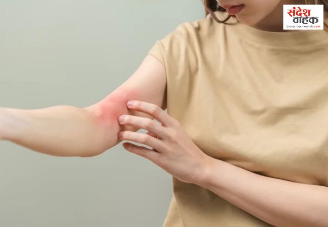 मच्छर काटते ही त्वचा पर बड़ी सूजन और छाले? जानें क्या है स्किटर सिंड्रोम